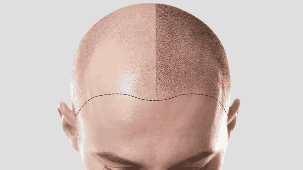 Benefits of Scalp Micropigmentation for Thinning Hair