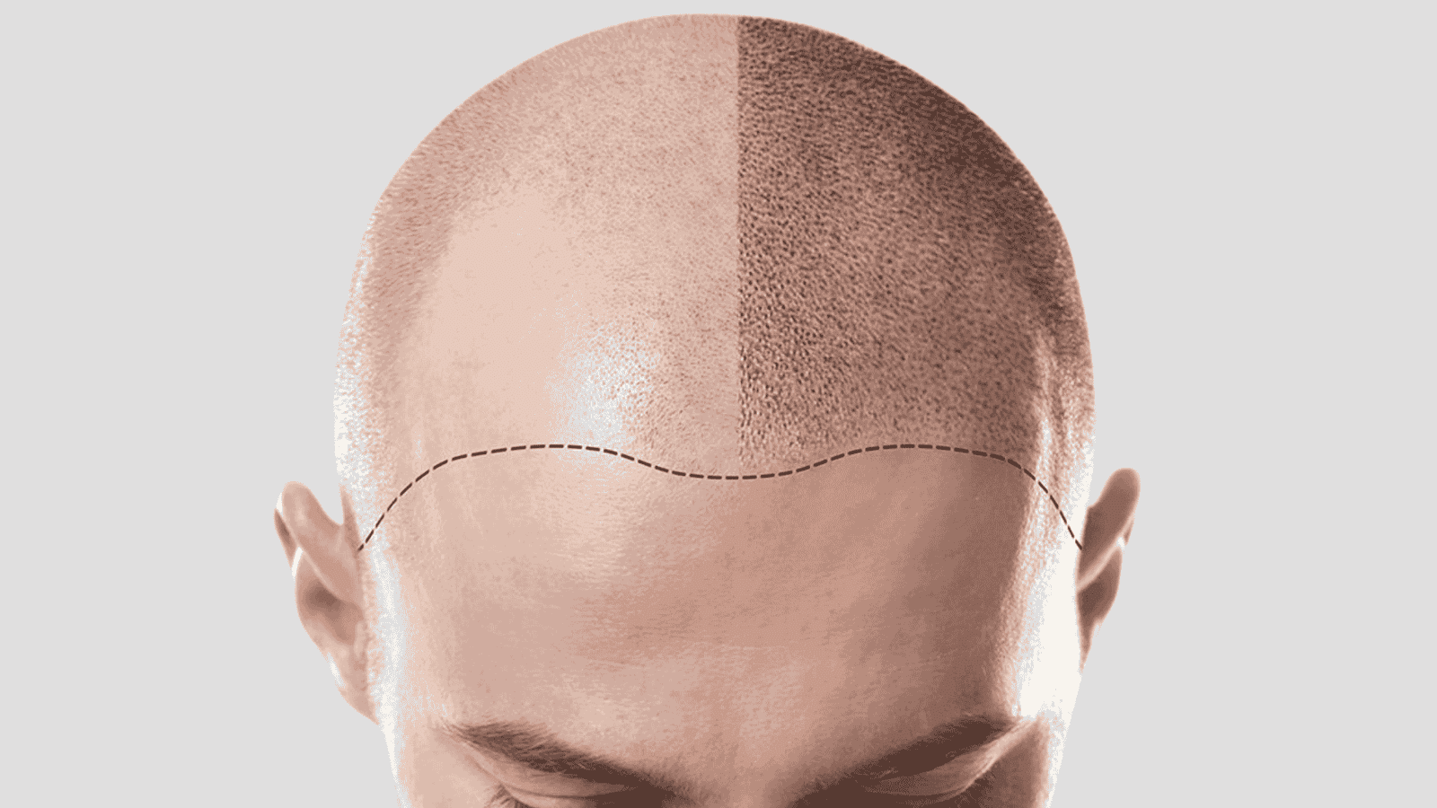 Benefits of Scalp Micropigmentation for Thinning Hair