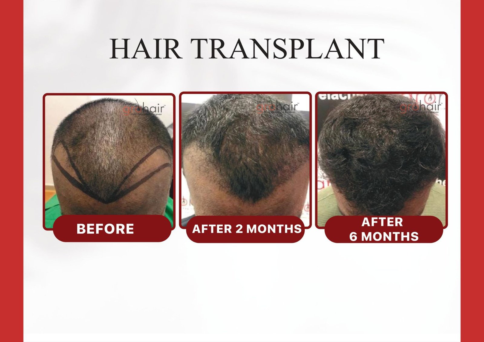 hair transplant in Ambattur