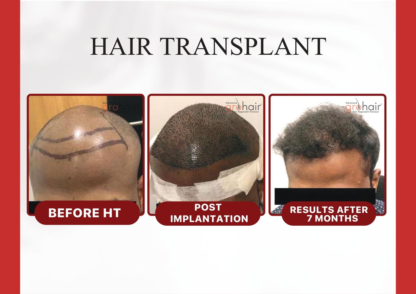 Hair transplant in Velachery