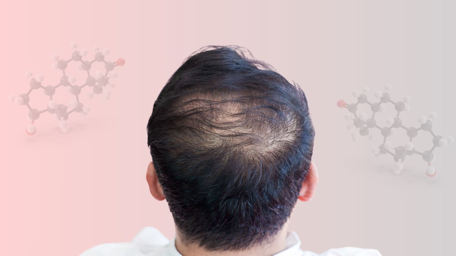 How to Remove DHT from Scalp