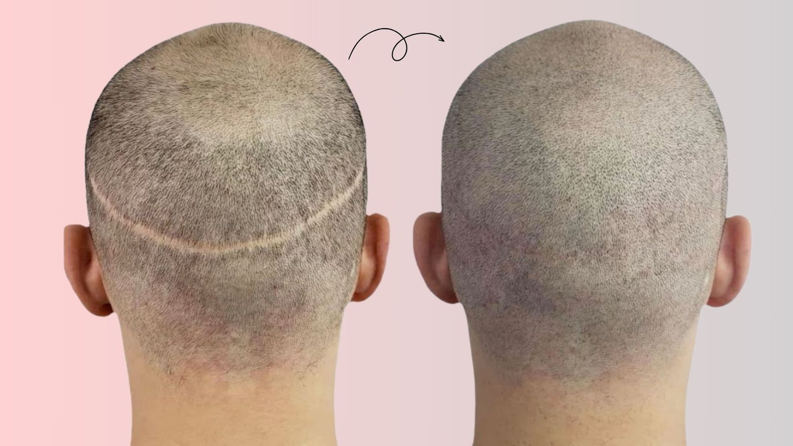How to Treat Hair Transplant Scar