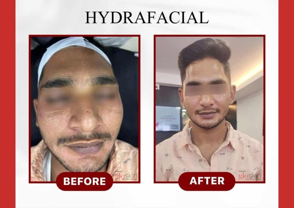 Hydrafacial Men