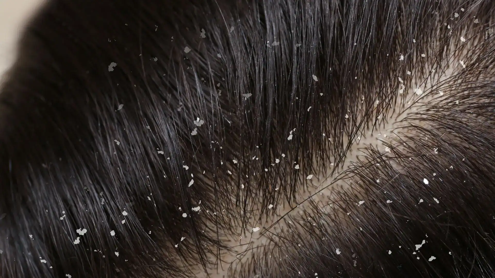 can dandruff cause hair loss?