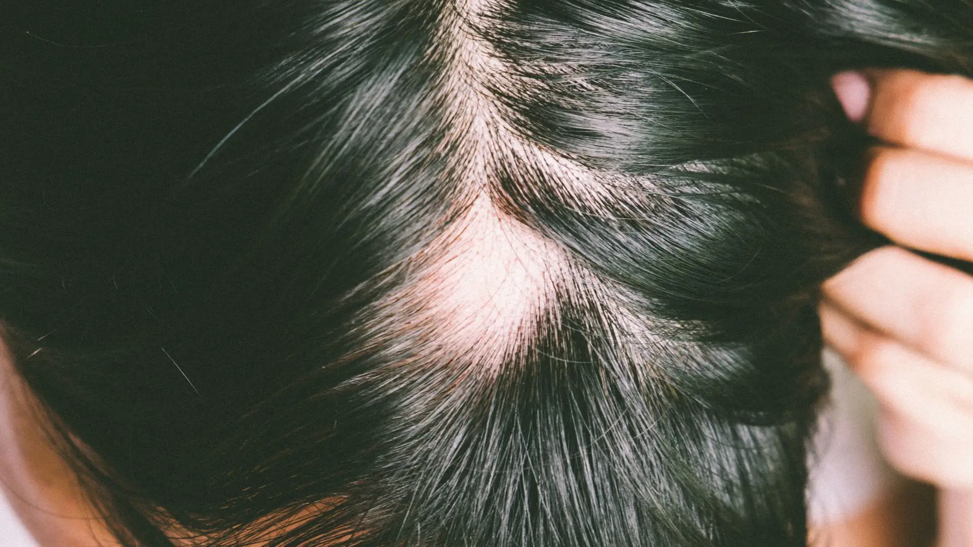 Female Pattern Hair Loss Treatment in Chennai