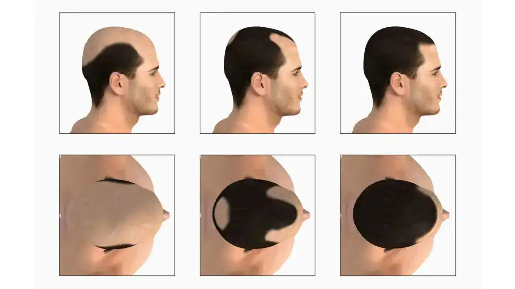 Male pattern Baldness