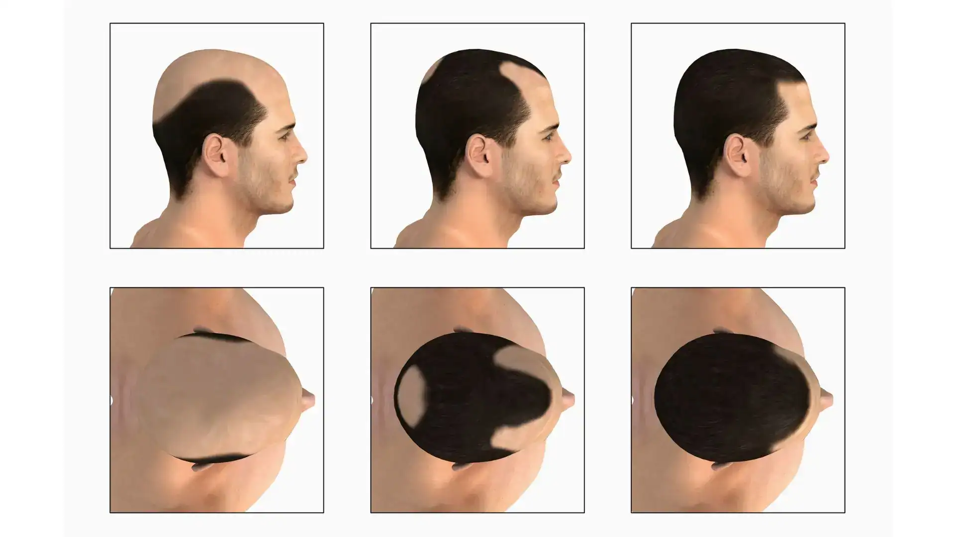 Male pattern Baldness