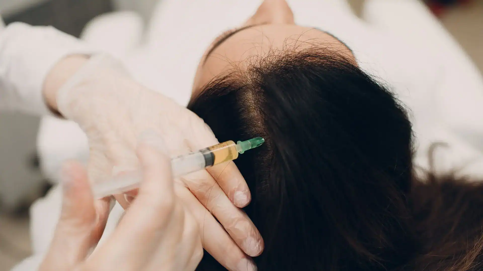 Mesotherapy for Hair Loss