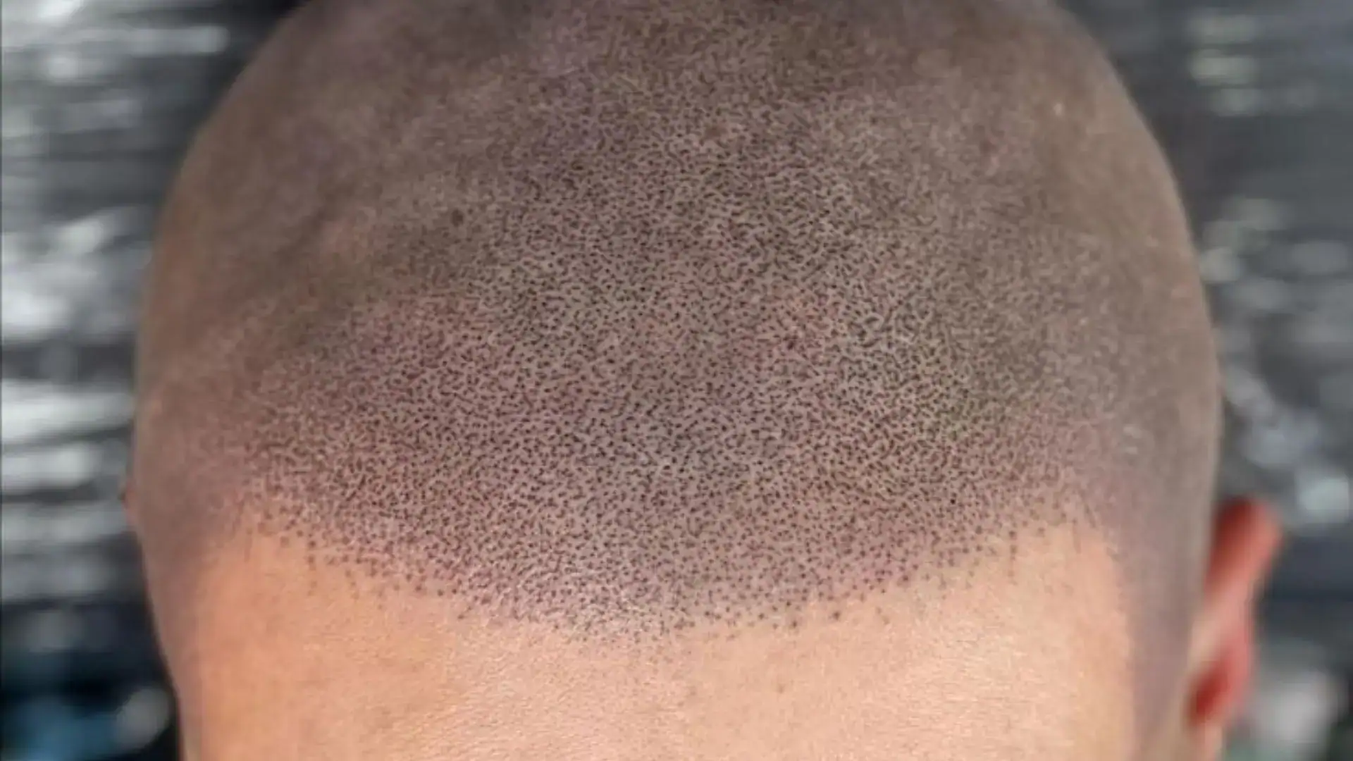 Scalp Micropigmentation Removal in Chennai