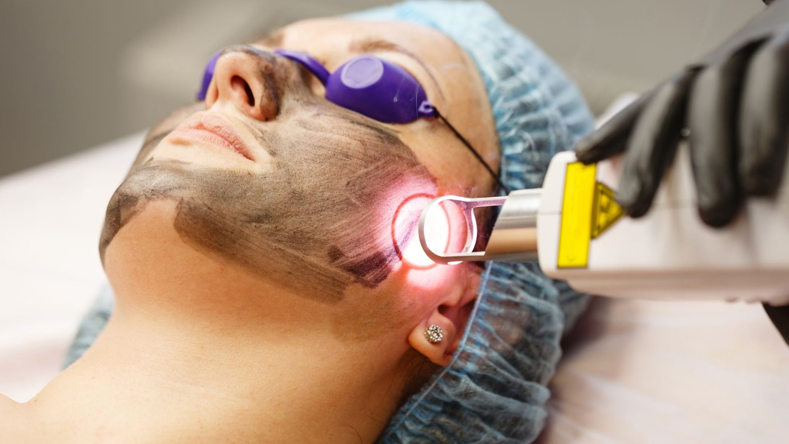 q switch laser for pigmentation