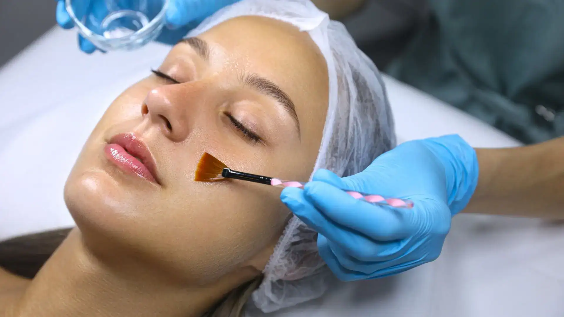 Chemical Peel for Skin Whitening
