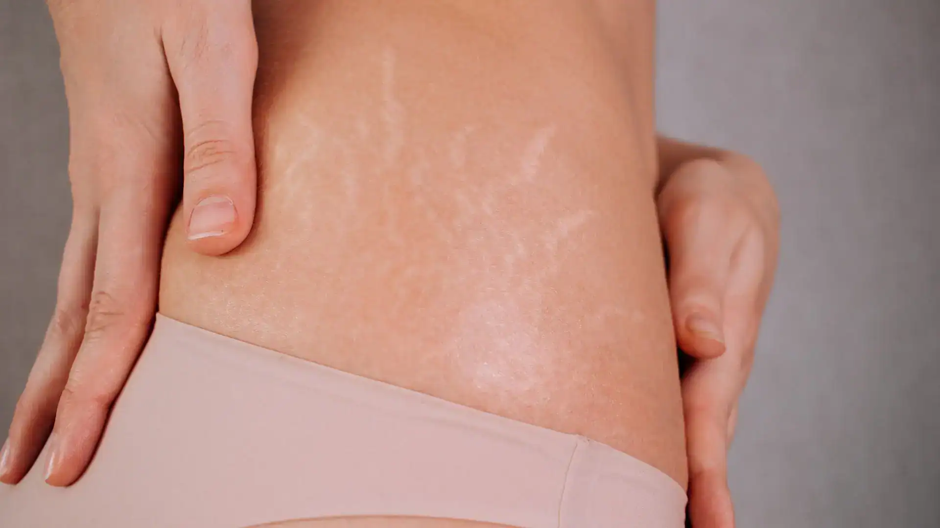Microdermabrasion for Stretch Marks