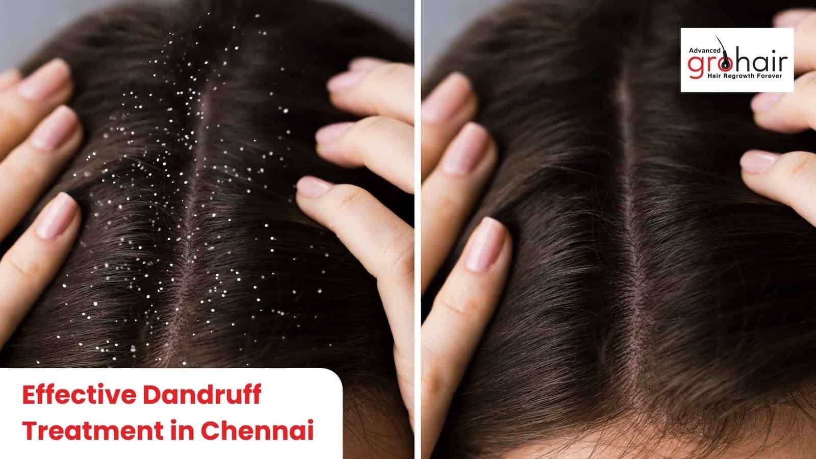 Effective Dandruff Treatment in Chennai