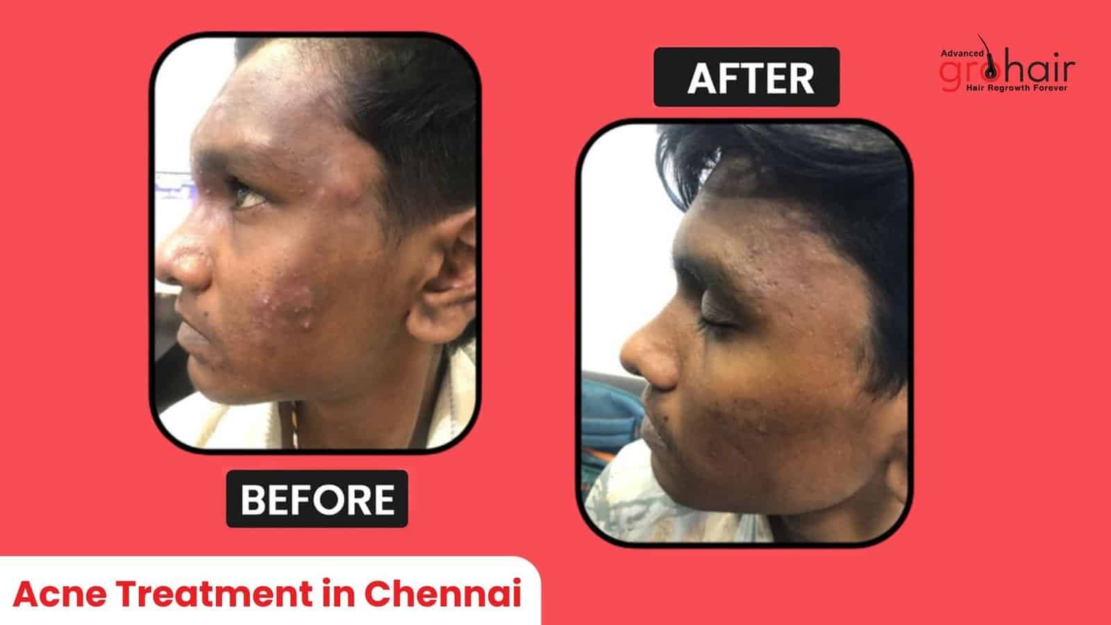 Acne Treatment in Chennai