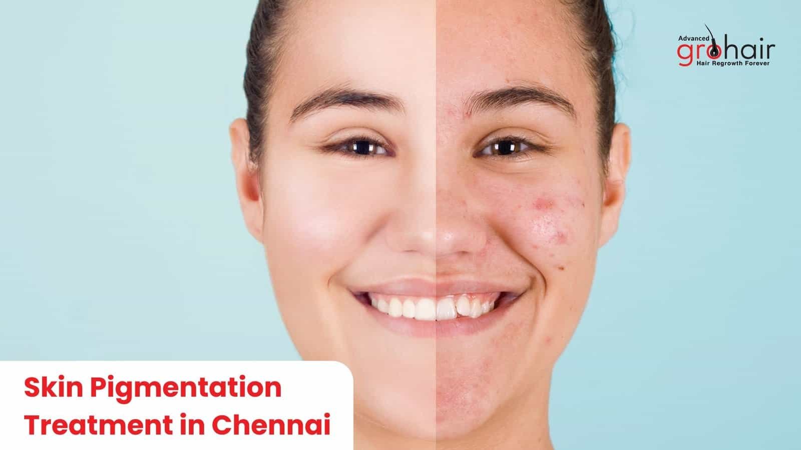 Skin Pigmentation Treatment in Chennai