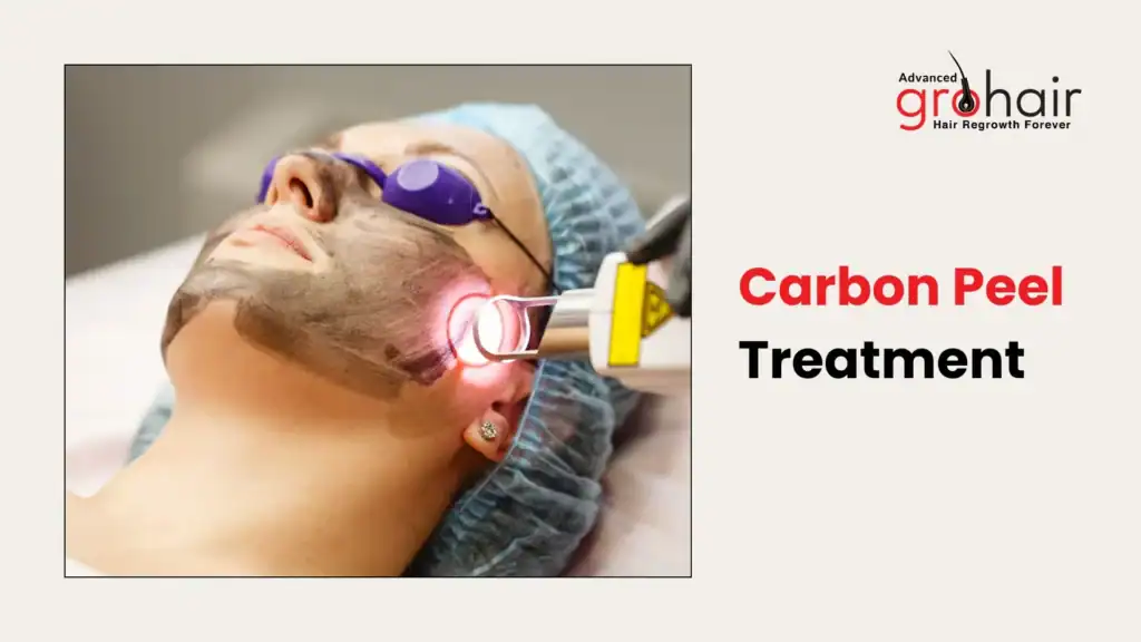 Carbon Peel Treatment - benefits, procedure, cost