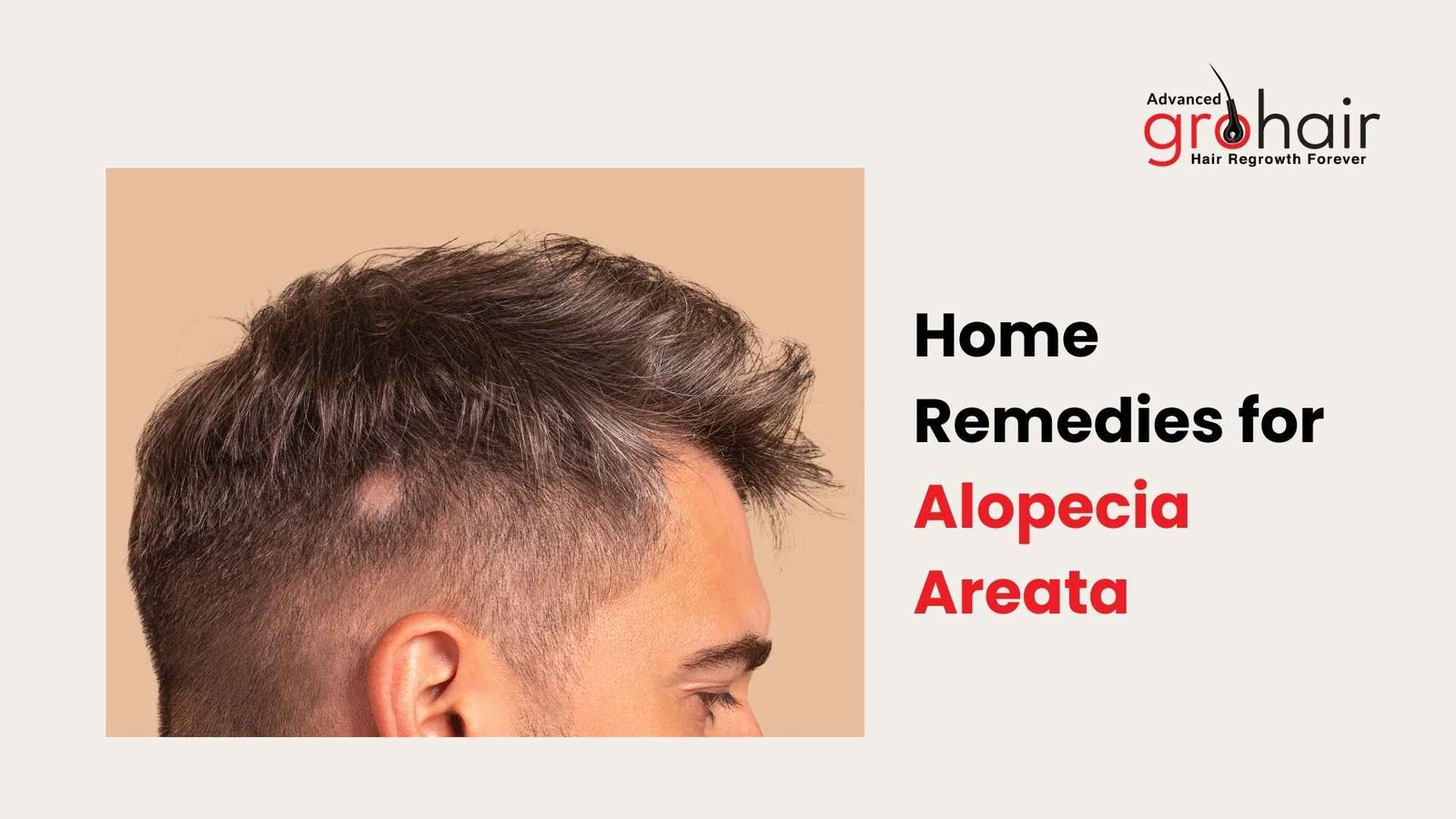 Home Remedies for Alopecia Areata