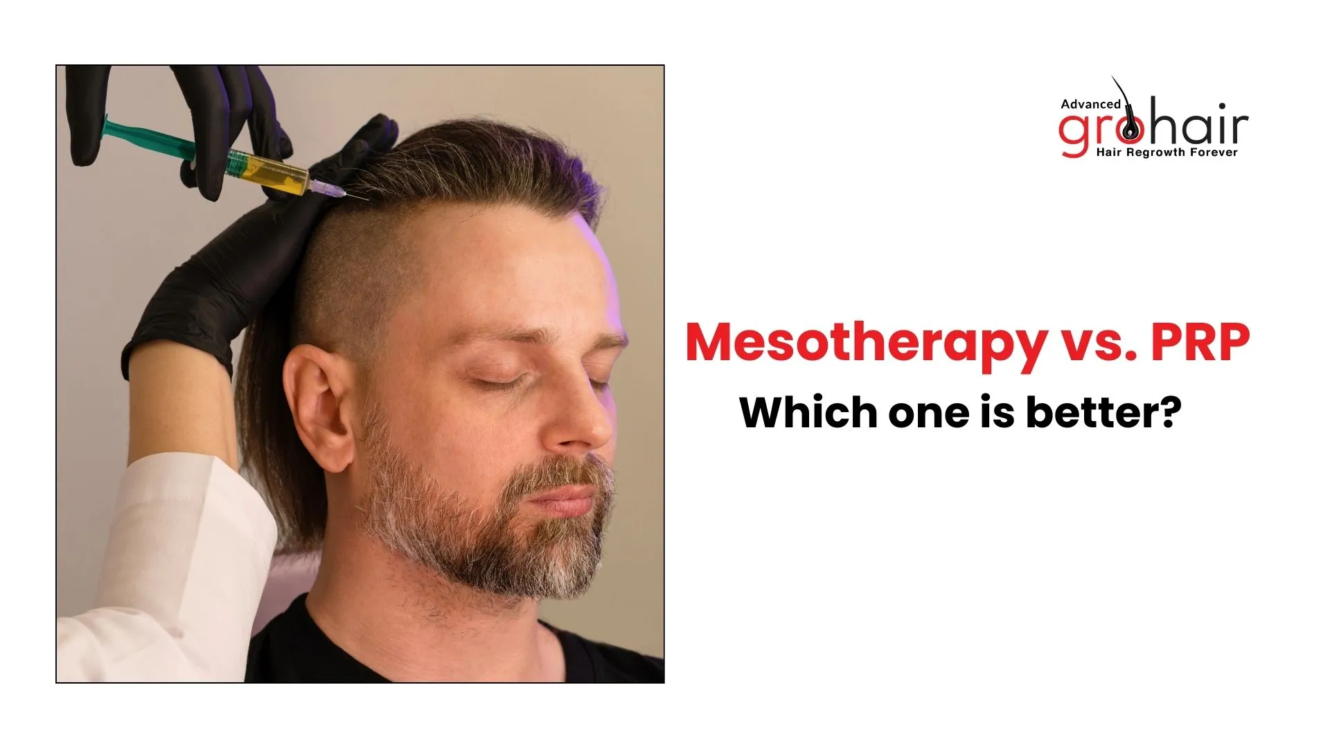 Mesotherapy vs. PRP