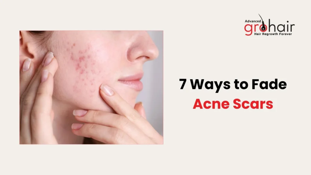 7 Ways to Fade Acne Scars