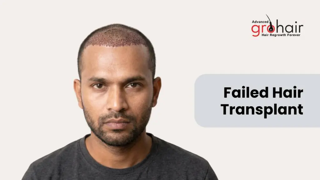 Failed Hair Transplant