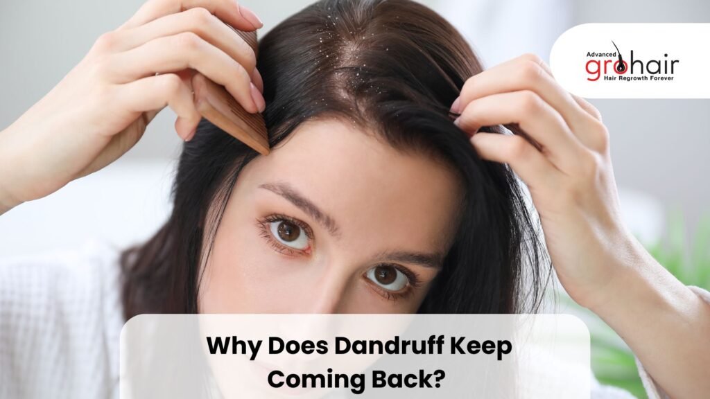 Why Does Dandruff Keep Coming Back