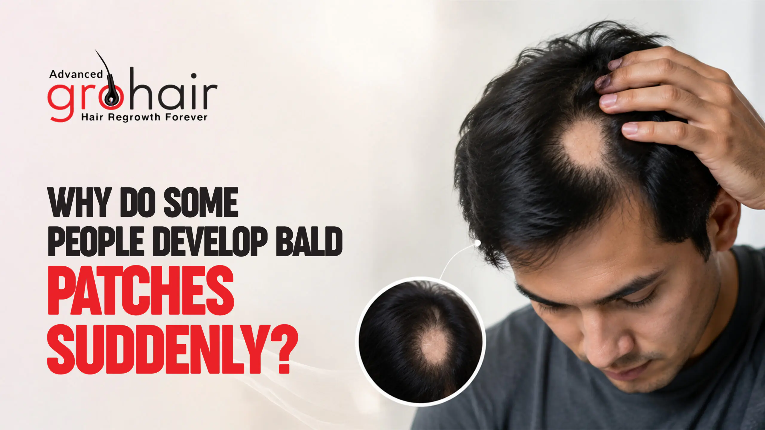 Why Do Some People Develop Bald Patches Suddenly? Causes & Treatment