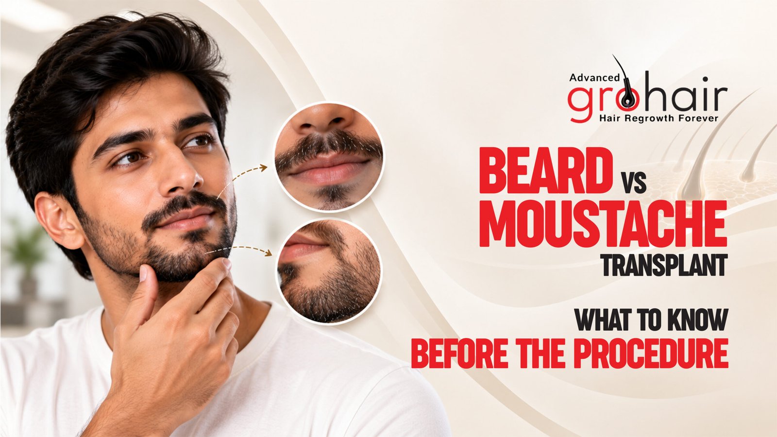 Beard and Moustache Transplant: What to Know Before the Procedure