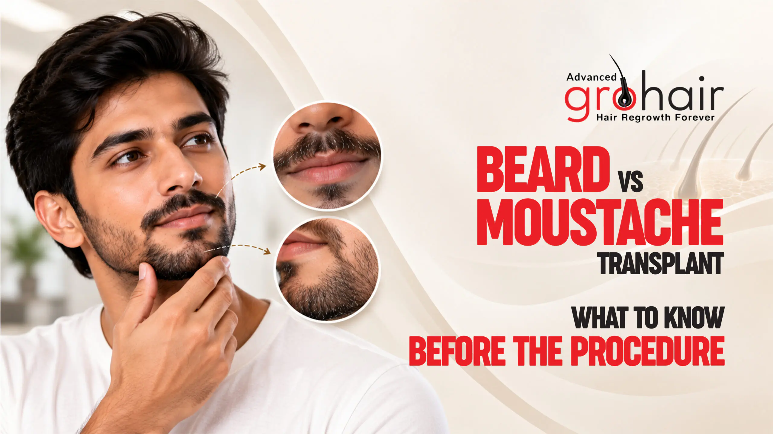 Beard and Moustache Transplant: What to Know Before the Procedure